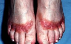 contact-dermatitis-feet