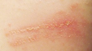 Contact_dermatitis_around_wound_leg
